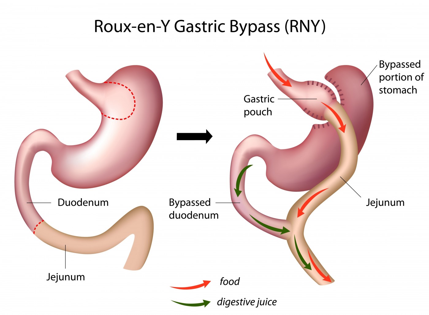 Preparation For Gastric Bypass What You Need To Know