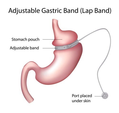 gastric banding