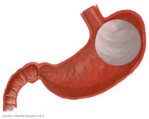 New York Bariatric Group Specialist Among the First To Perform Orbera Procedure in US