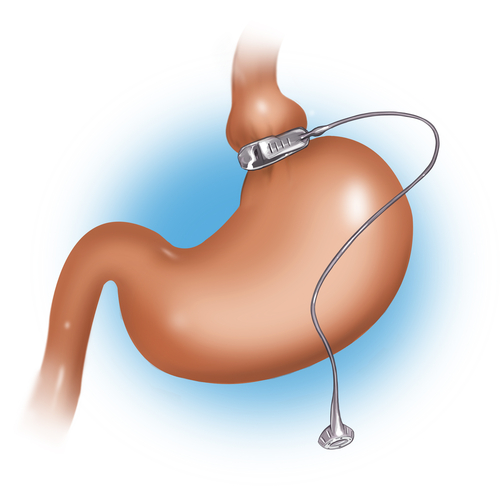 Gastric Bypass Found to Increase Brown Adipose Tissue Activity