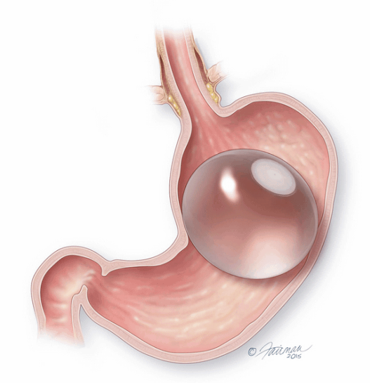 ORBERA Intragastric Balloon Non-Surgical Weight Loss Device Receives FDA Approval